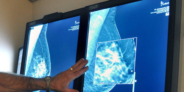 FILE - In this Tuesday, July 31, 2012, file photo, a radiologist compares an image from earlier, 2-...