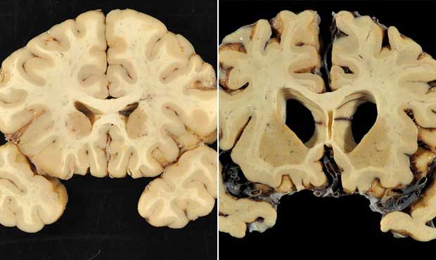 This combination of photos provided by Boston University shows sections from a normal brain, left, ...