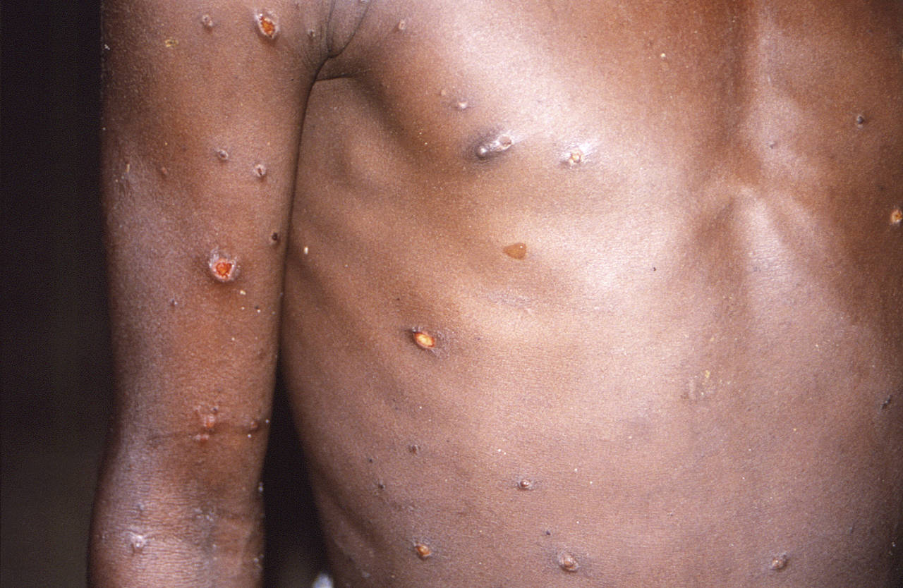 FILE - This 1997 image provided by U.S. Centers for Disease Control and Prevention shows the right ...