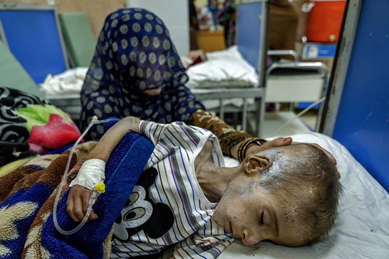 FILE - A mother holds her malnourished boy at the Indira Gandhi hospital in Kabul, Afghanistan, Sun...