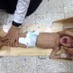 
              Doctors measure a malnourished boy at Hays Rural Hospital in Hodeida, Yemen, Oct. 11, 2022. For years starvation has been an everyday threat for Yemen’s children. Now, as the war threatens to escalate between the country’s warring parties after months of a tenuous truce, there are fears that it could get worse. (AP Photo/Hussam Al-Bakry)
            