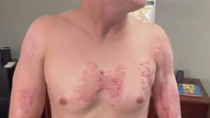 Man burned on hot Phoenix pavement sues city over police actions