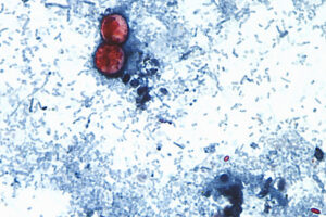 US officials tie cyclospora outbreak involving iceberg lettuce to 3 more states