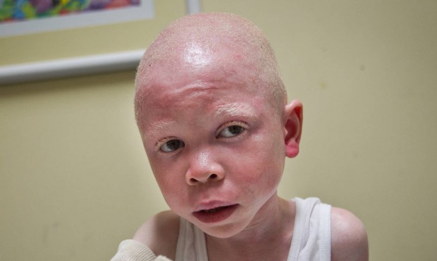 n Baraka Cosmas Rusambo, 6 years old with albinism from Tanzania, is treated at Global Medical Reli...